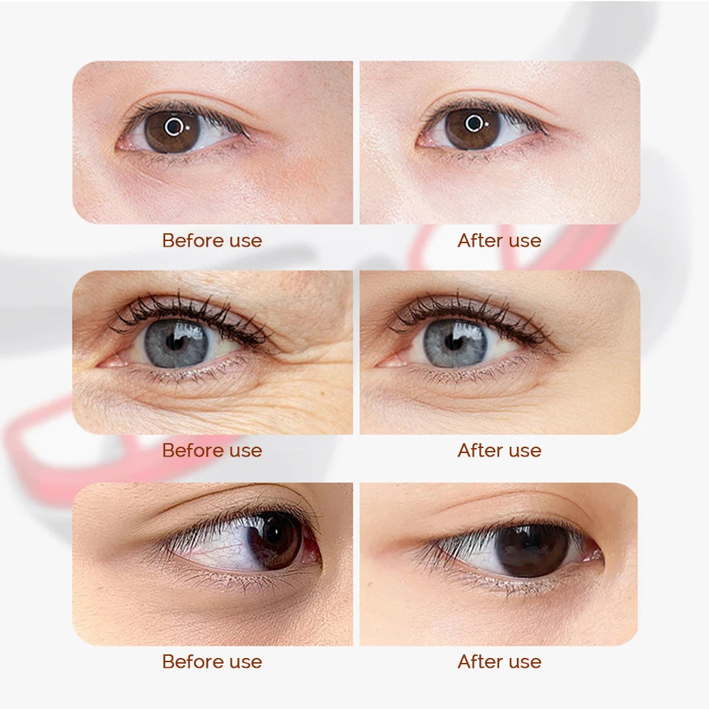 Eye Massager Dark Circles Eye Bag Removal Eye Care Beauty Machine